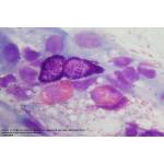 Rinite non allrgica eosinofilo-mastocitaria (NARESMA)
